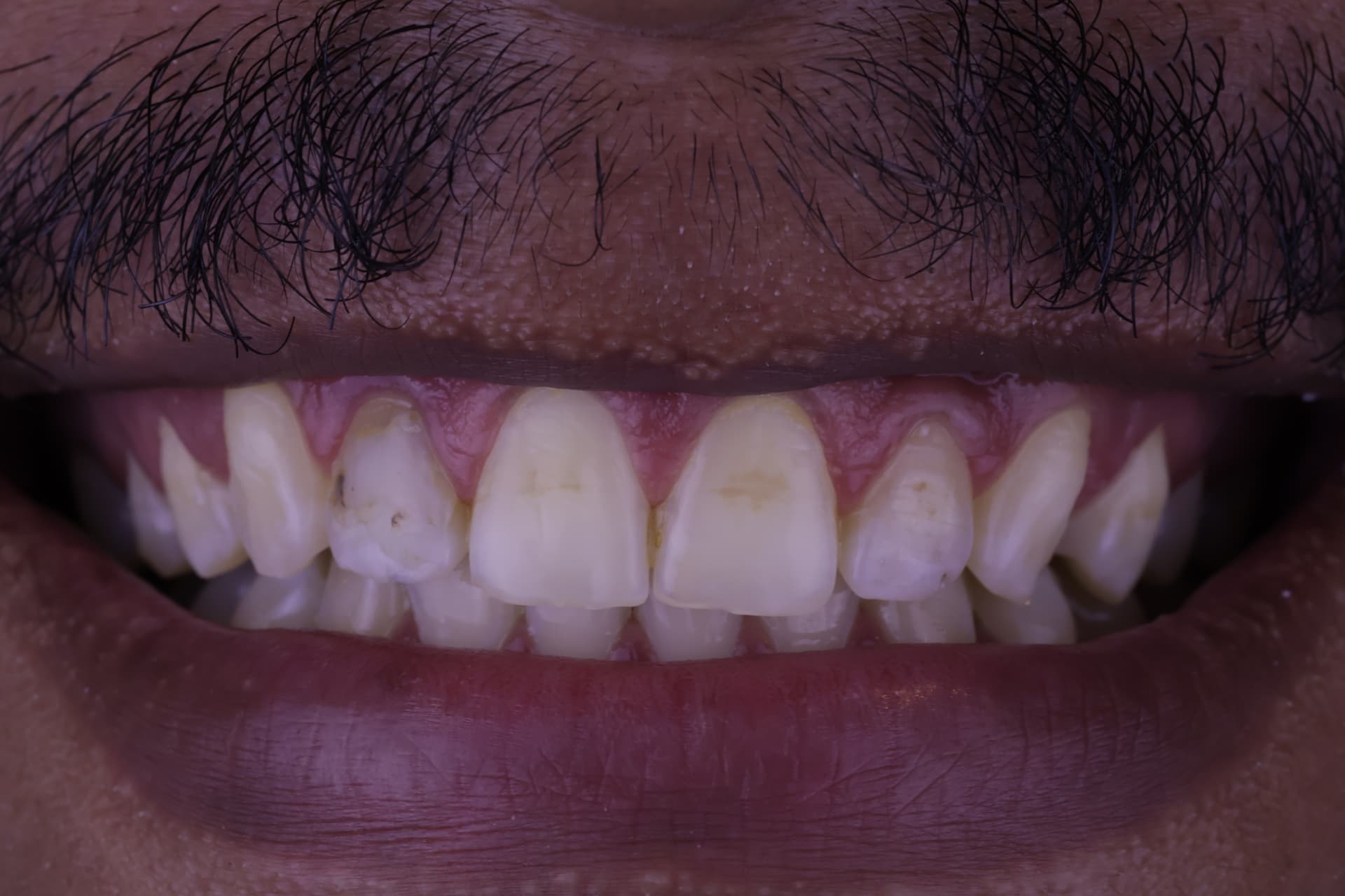 Registro do sorriso de um paciente da Odontoclycie