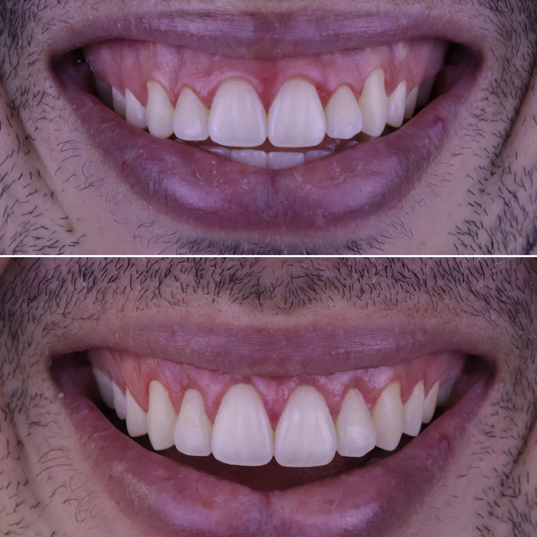 Registros de resultado de tratamento do sorriso na Odontoclycie